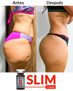 Inicio 2 Celulitis-___
