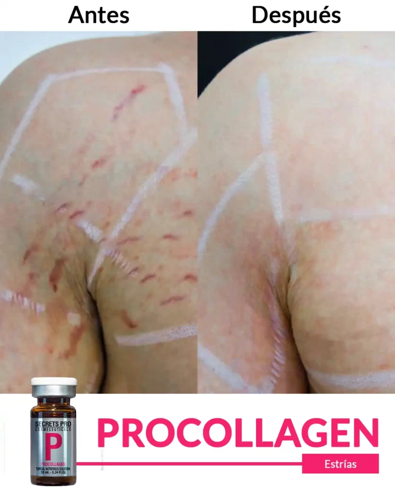 Productos 61 Estrías