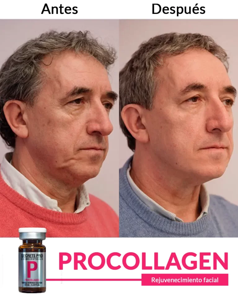 Productos 39 Rejuvenecimiento-facial--2
