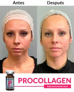 Inicio 21 Rejuvenecimiento-facial--4