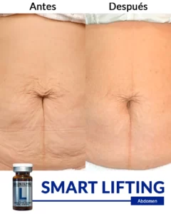 Inicio 4 SMART-LIFTING-abdomen-1