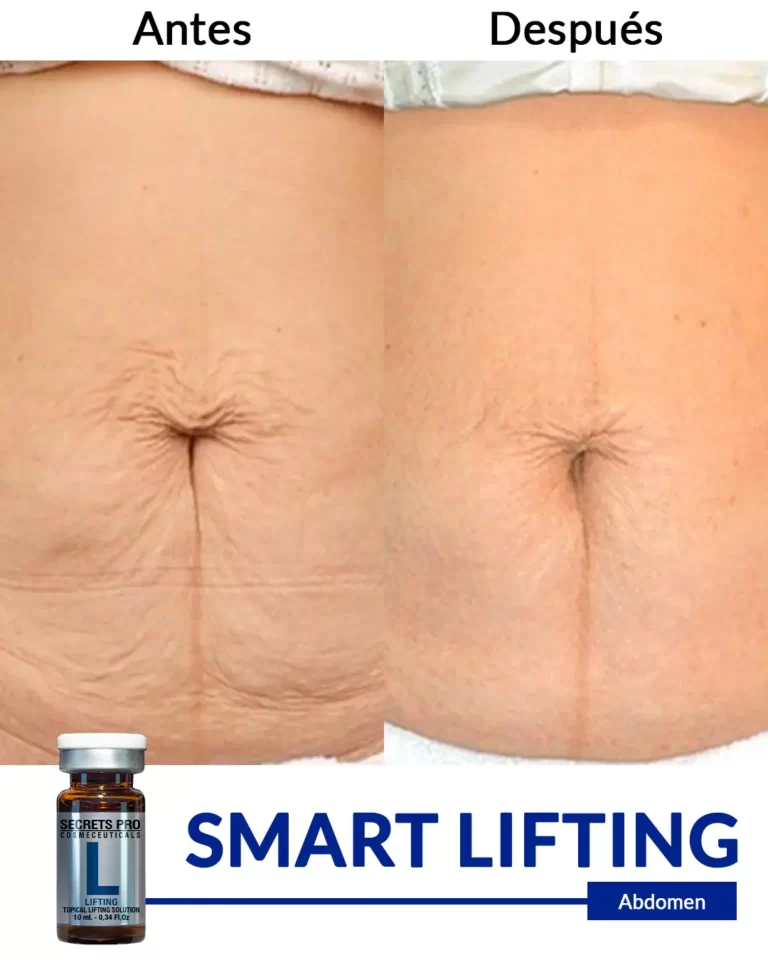 Productos 15 SMART-LIFTING-abdomen-1