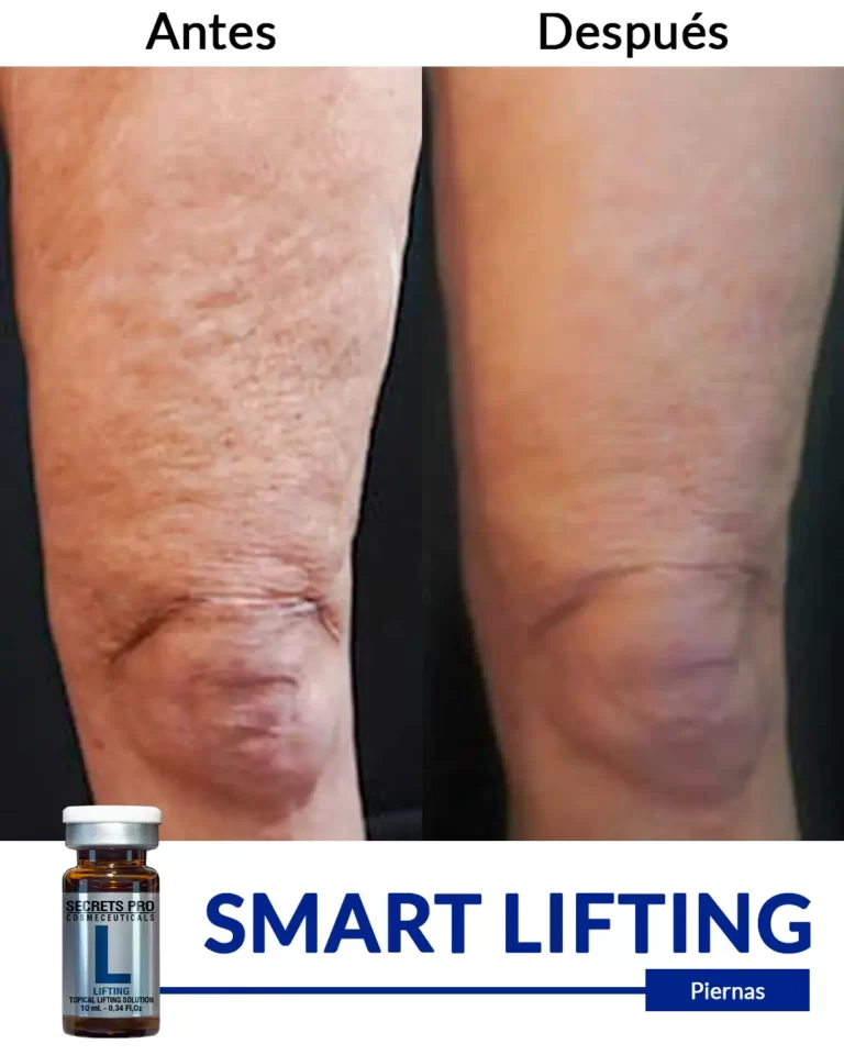 Productos 59 SMART-LIFTING-piernas-1