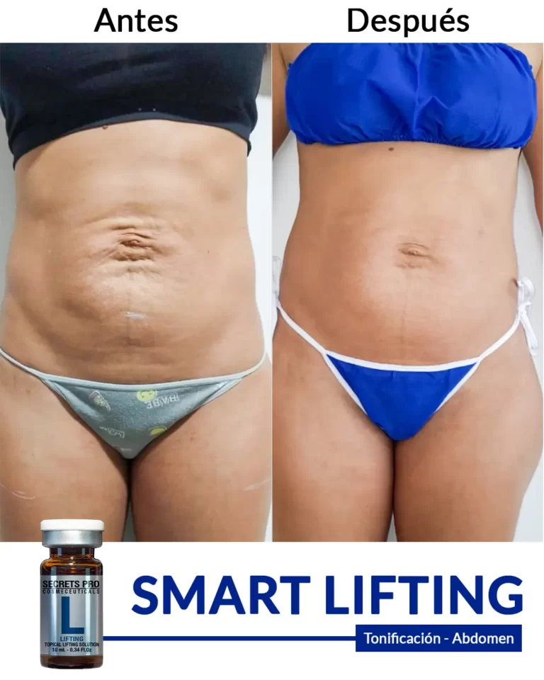 Productos 56 SMART-LIFTING-tonificación-de-abdomen-1