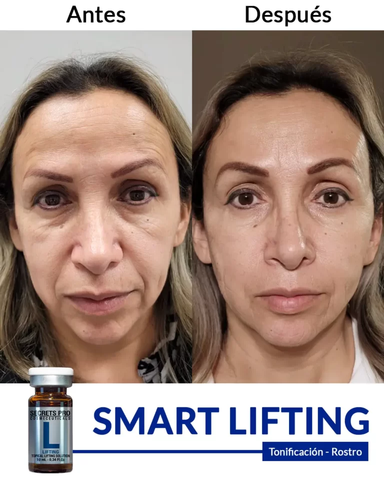 Productos 46 SMART-LIFTING-tonificación-de-rostro-1