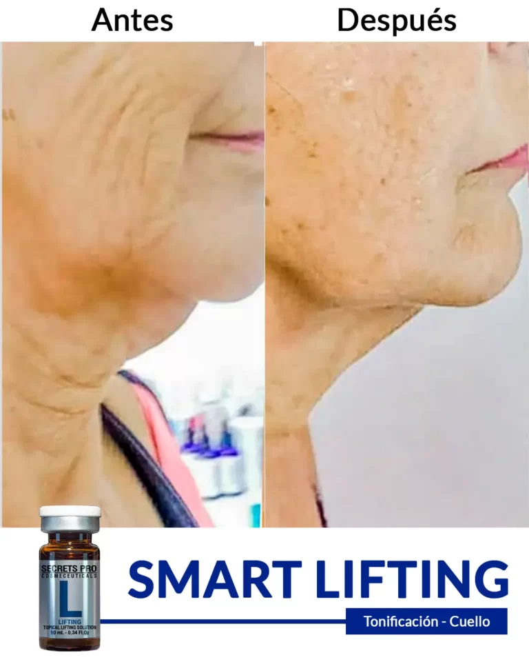 Productos 25 SMART-LIFTING-tpnificación-de-cuello-1