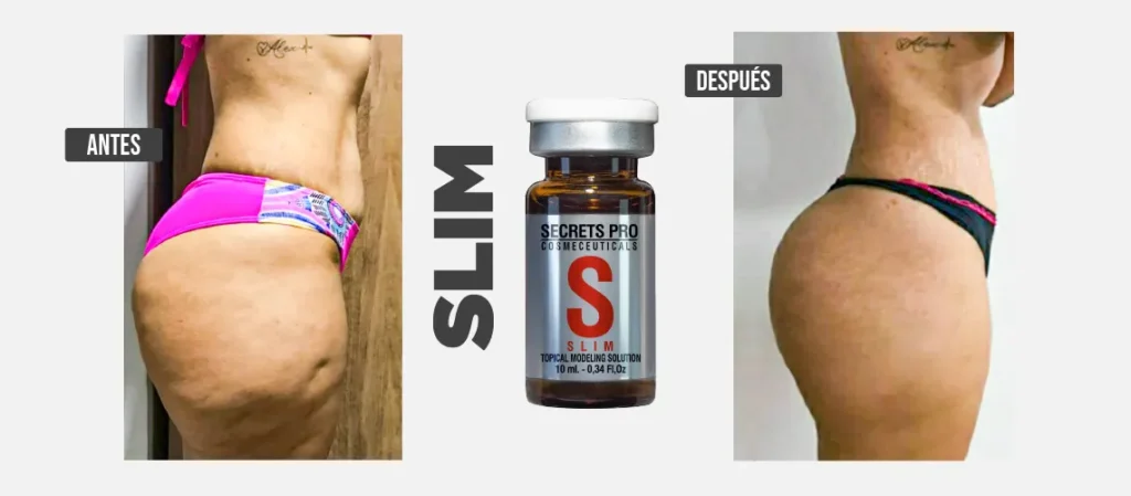 Mesoterapia para Eliminar la Grasa Localizada. 3 Resultados mesoterapia para eliminar la grasa