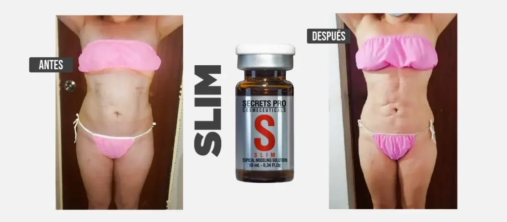Mesoterapia para Eliminar la Grasa Localizada. 2 Resultados mesoterapia con slim