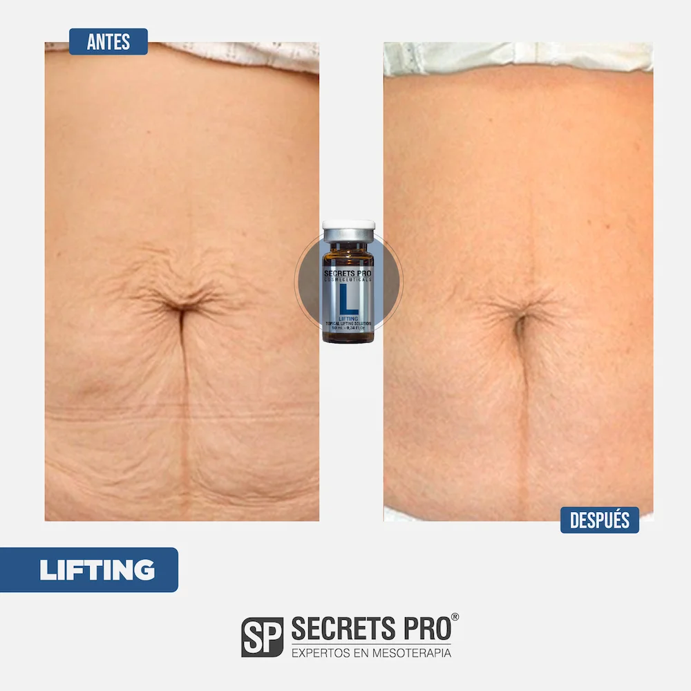 L - SMART LIFTING 5 Antes y Despues Junio 2024_L 2