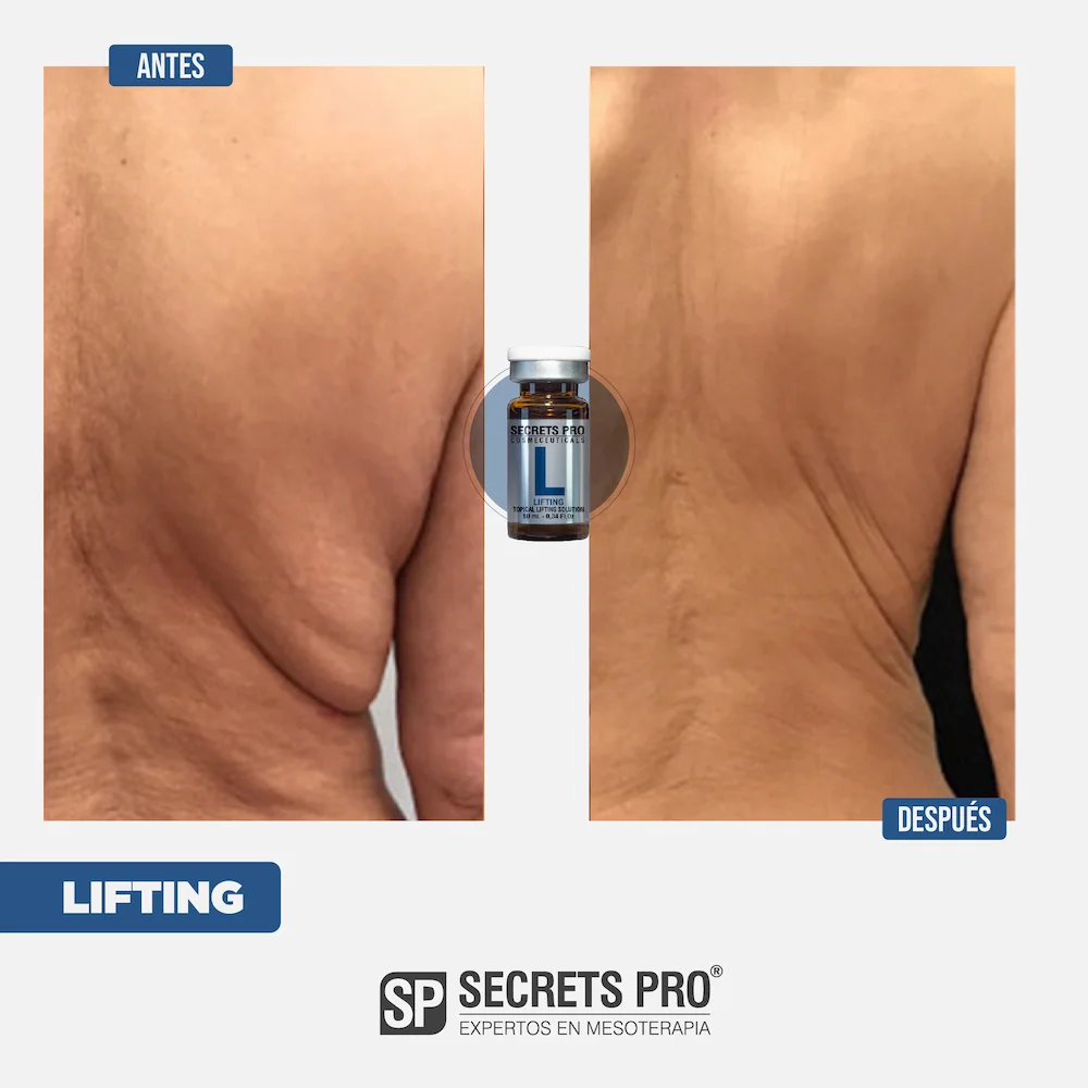 L - SMART LIFTING 6 Antes y Despues Junio 2024_L 3
