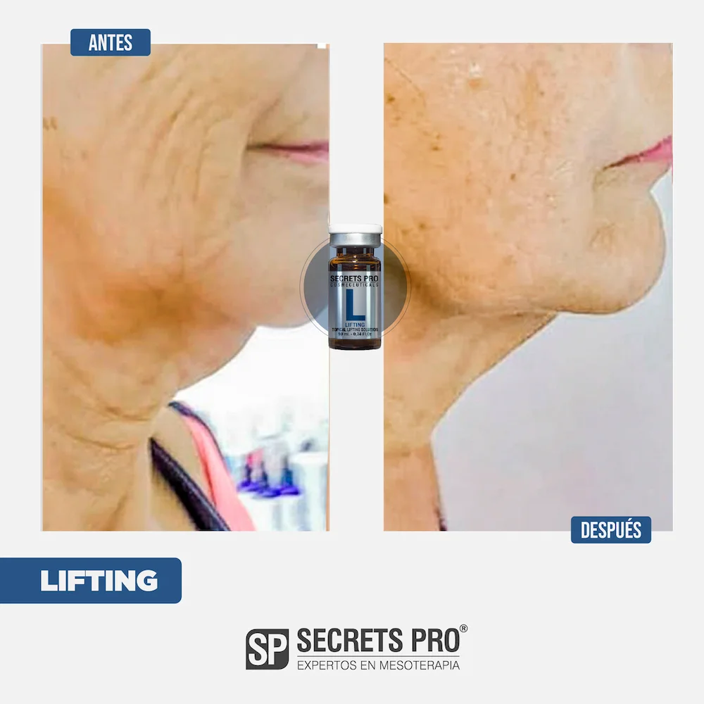 L - SMART LIFTING 4 Antes y Despues Junio 2024_L