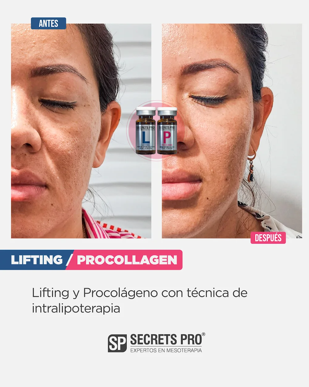 L - SMART LIFTING 8 Antes y Despues Junio 2024_LP