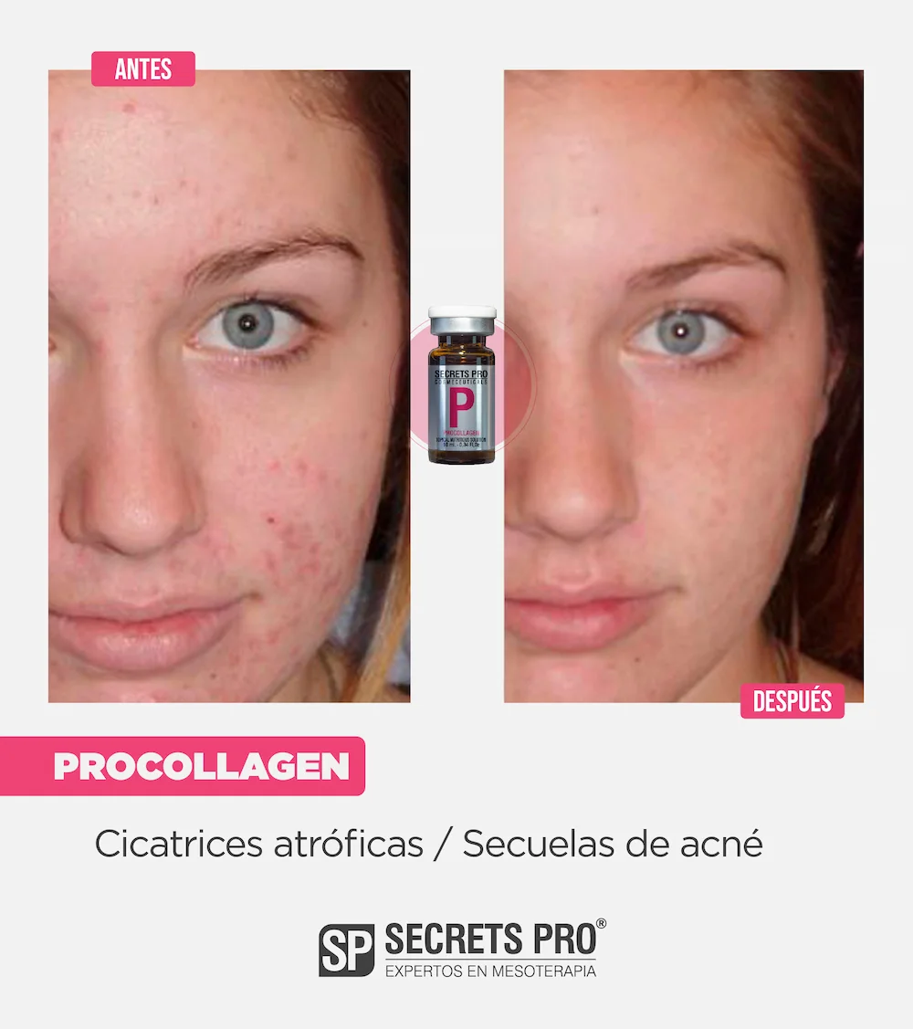 P - PROCOLLAGEN 7 Antes y Despues Junio 2024_P 2