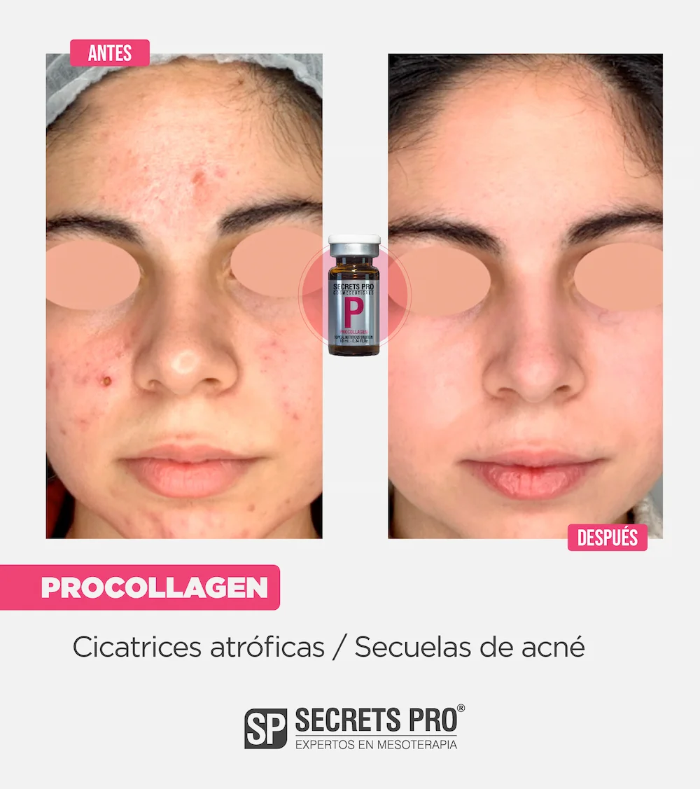P - PROCOLLAGEN 6 Antes y Despues Junio 2024_P