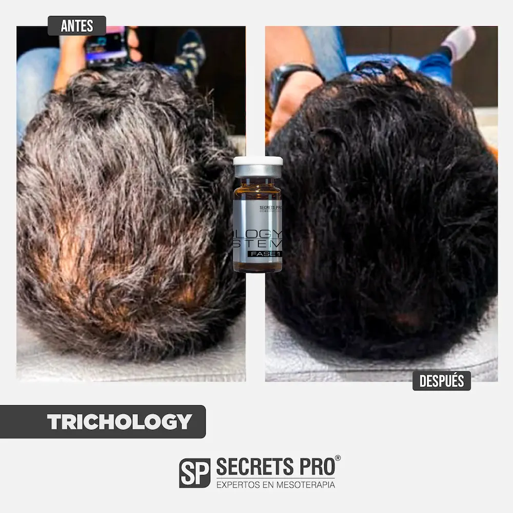 TRICHOLOGY 7 Antes y Despues Junio 2024_TRI 4