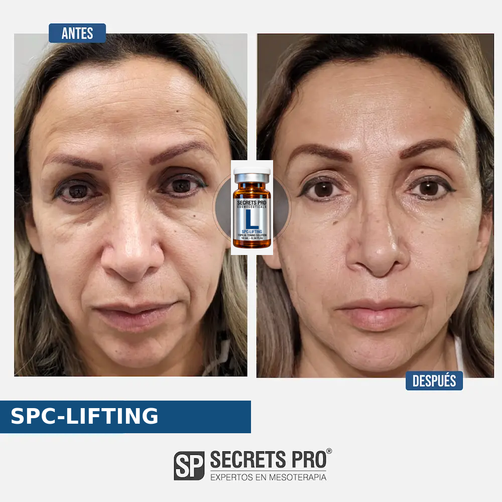 Registro de antes y después asociado a SPC-LIFTING, caso 18