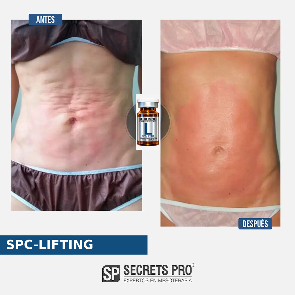 Evidencias 19 Registro de antes y después asociado a SPC-LIFTING, caso 19