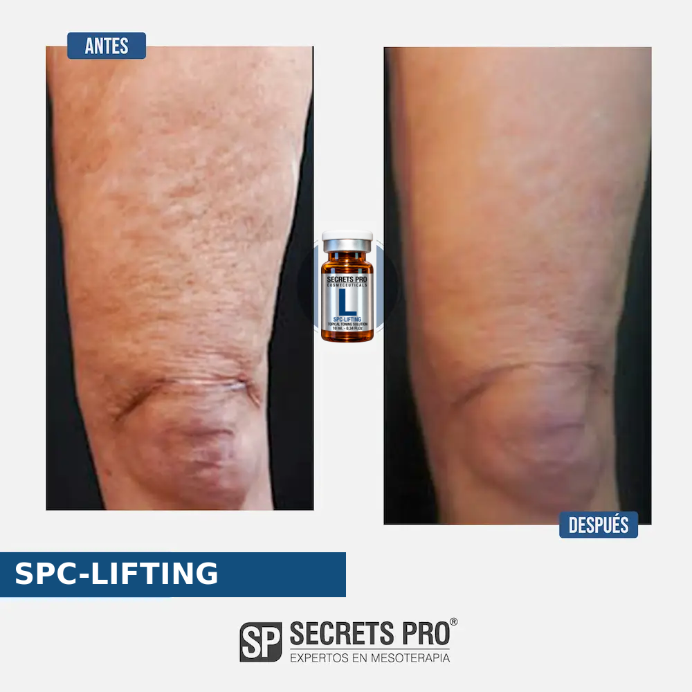 Evidencias 21 Registro de antes y después asociado a SPC-LIFTING, caso 21