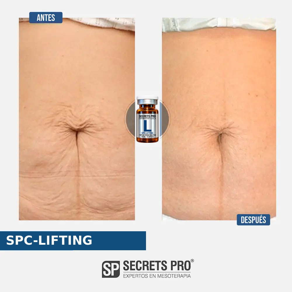 Evidencias 22 Registro de antes y después asociado a SPC-LIFTING, caso 22