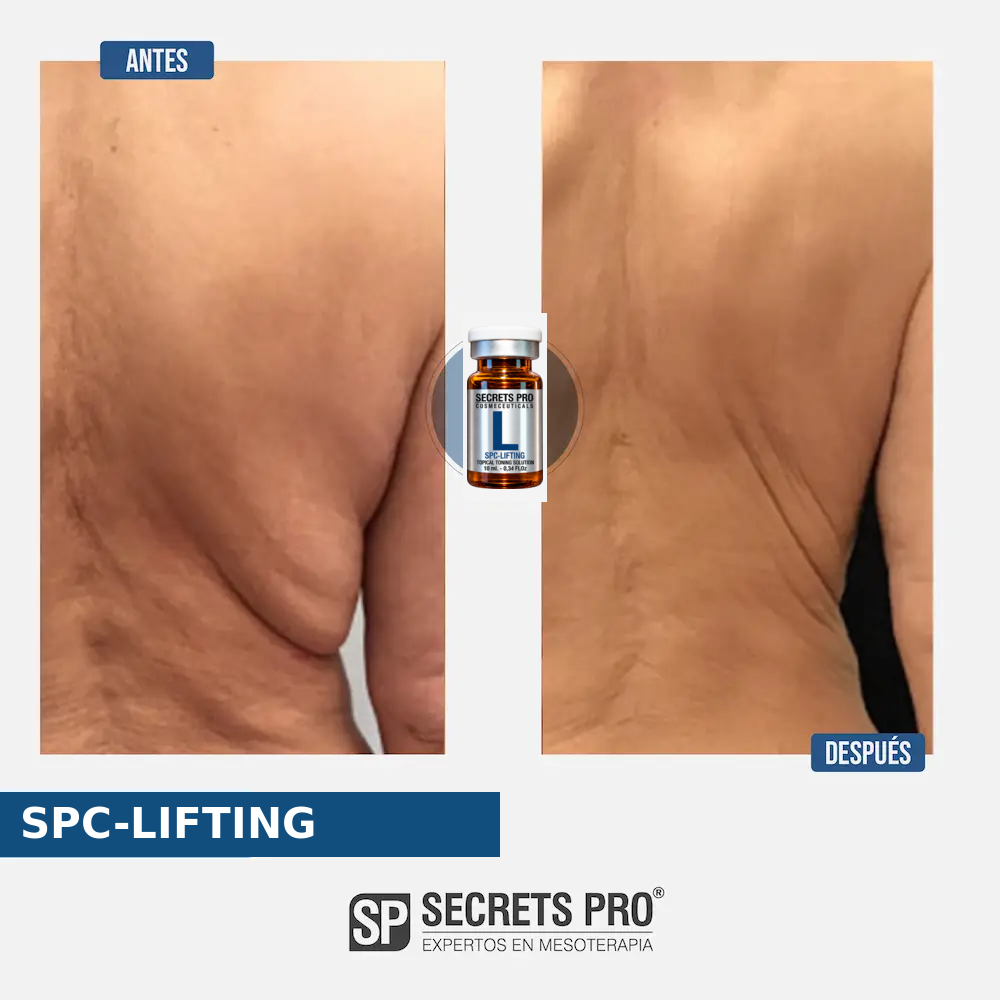Evidencias 23 Registro de antes y después asociado a SPC-LIFTING, caso 23
