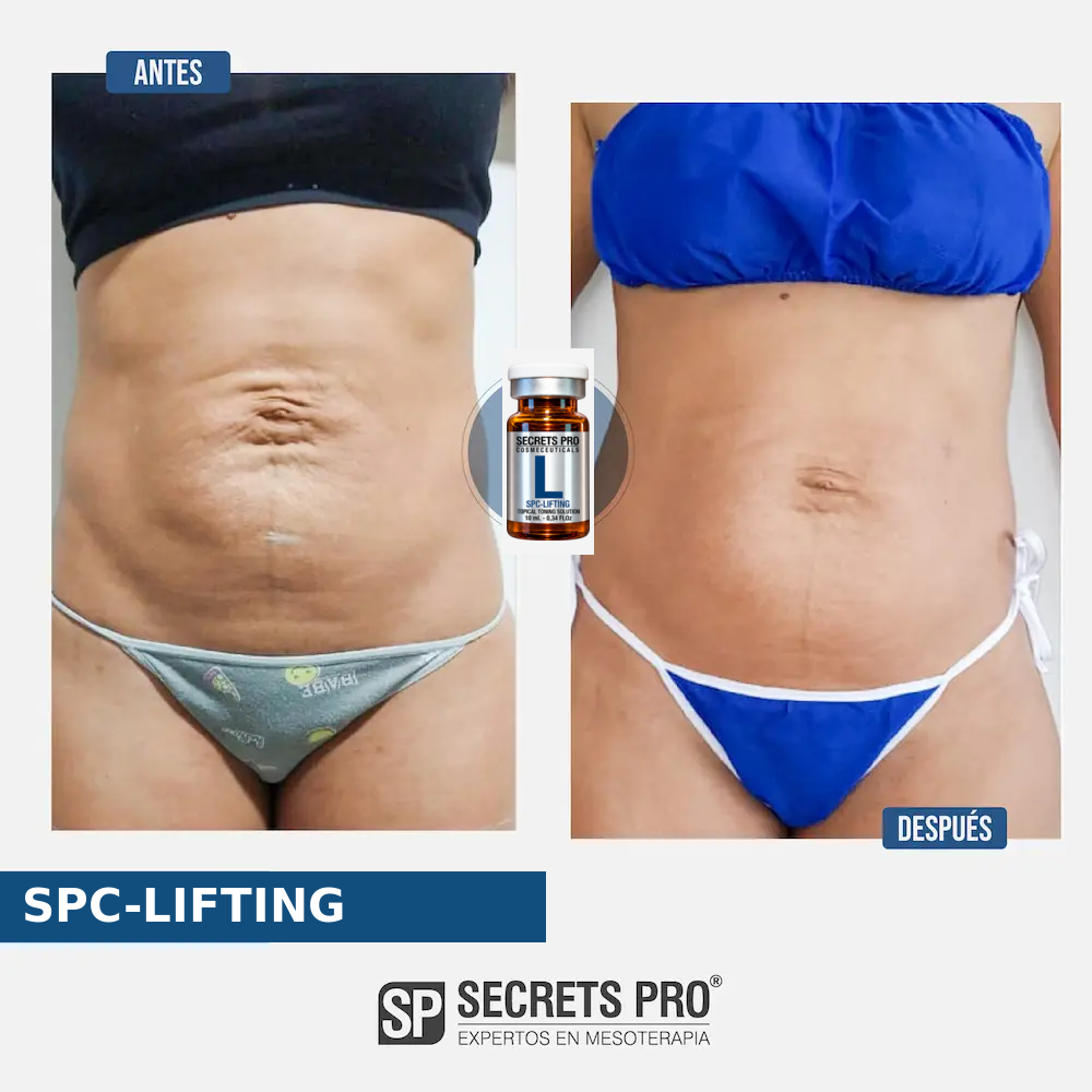 Evidencias 24 Registro de antes y después asociado a SPC-LIFTING, caso 24