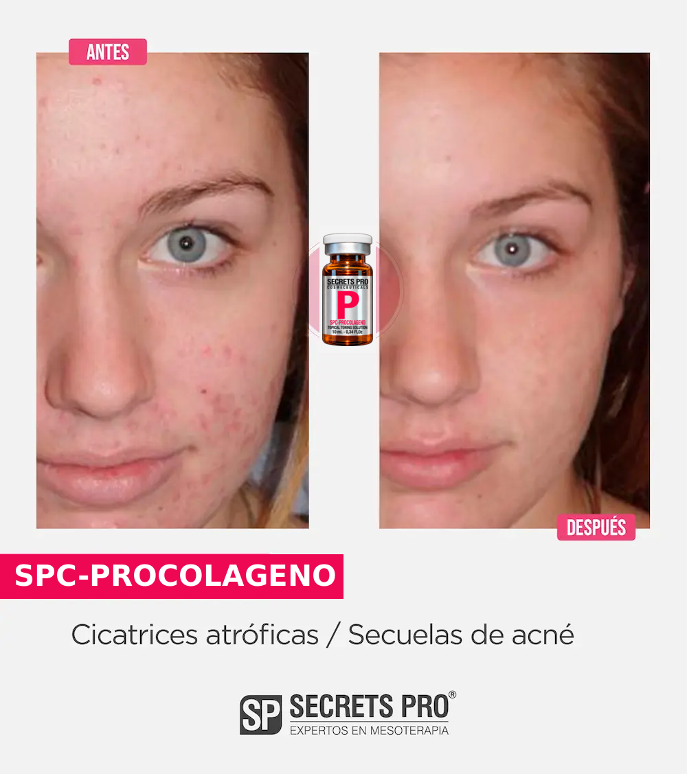 Evidencias 41 Registro de antes y después asociado a SPC-PROCOLAGENO, caso 41