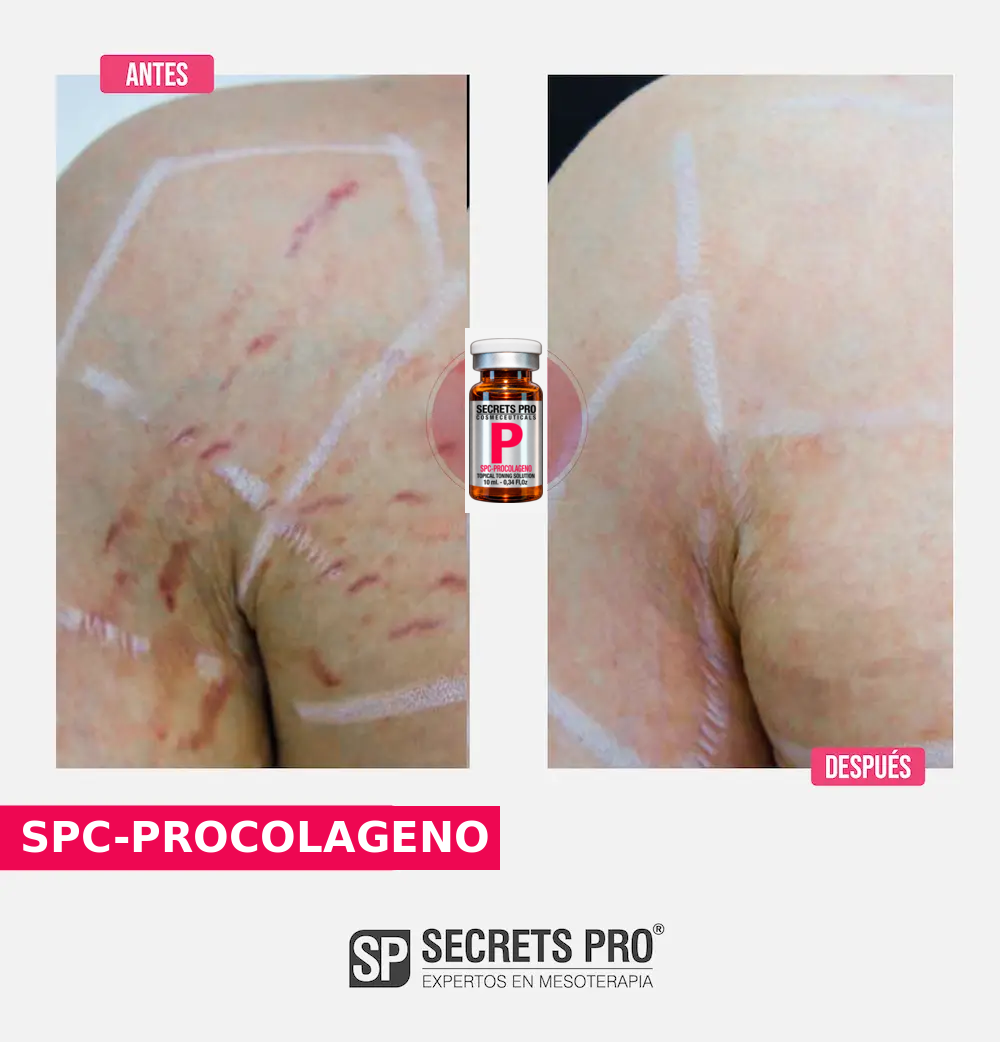 Evidencias 42 Registro de antes y después asociado a SPC-PROCOLAGENO, caso 42