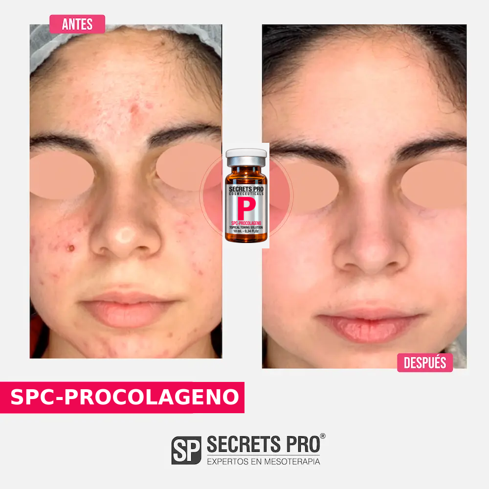 Evidencias 45 Registro de antes y después asociado a SPC-PROCOLAGENO, caso 45