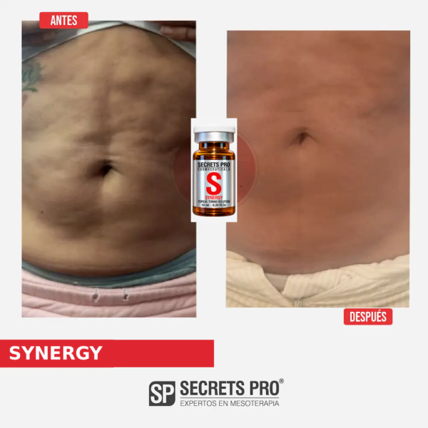 Registro de antes y después asociado a SYNERGY, caso 1