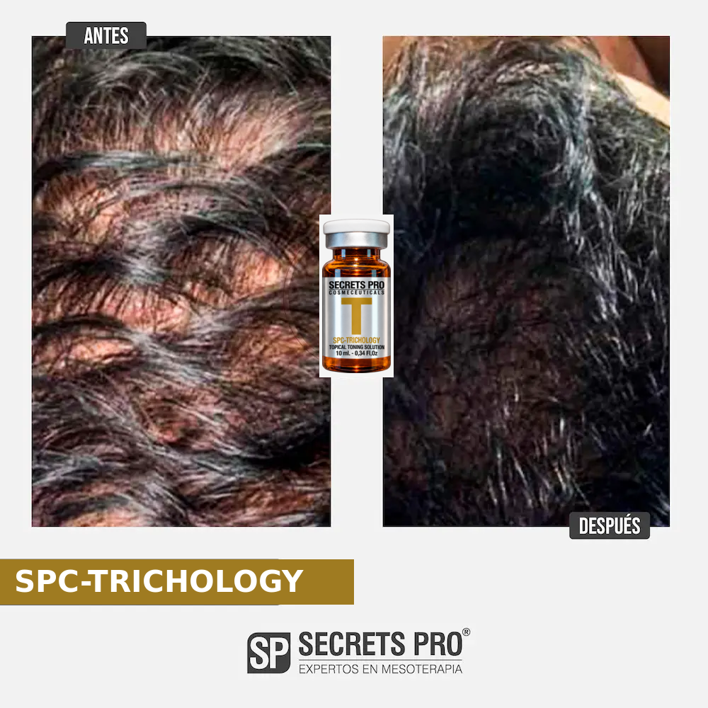 Evidencias 51 Registro de antes y después asociado a SPC-TRICHOLOGY, caso 51
