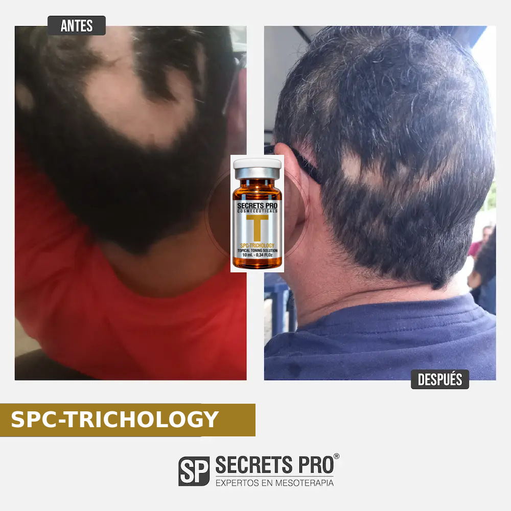 Evidencias 54 Registro de antes y después asociado a SPC-TRICHOLOGY, caso 54