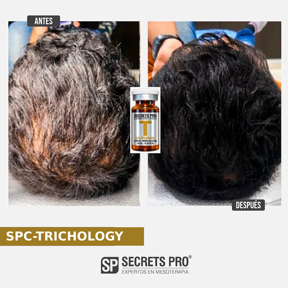 Evidencias 56 Registro de antes y después asociado a SPC-TRICHOLOGY, caso 56