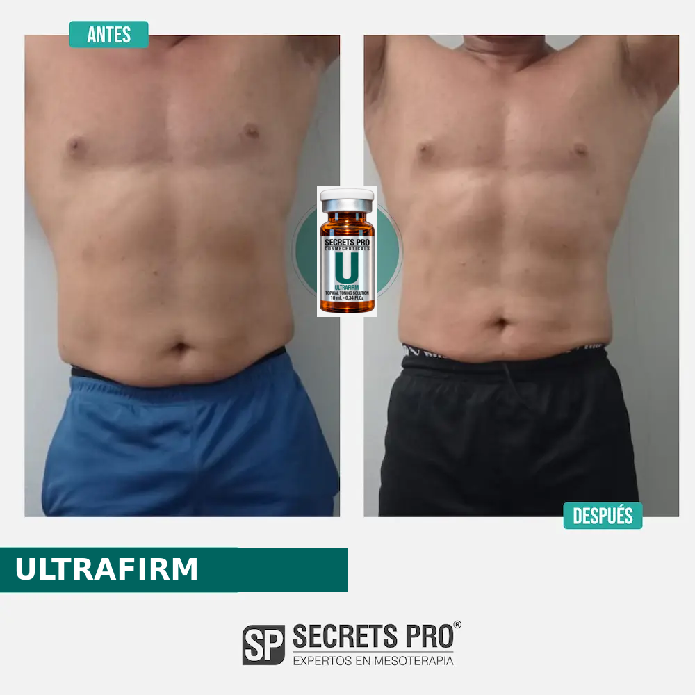 Registro de antes y después asociado a ULTRAFIRM, caso 35
